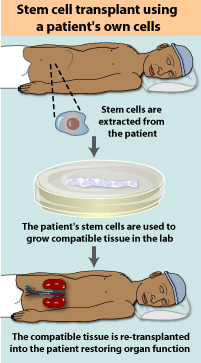 Transplant therapy